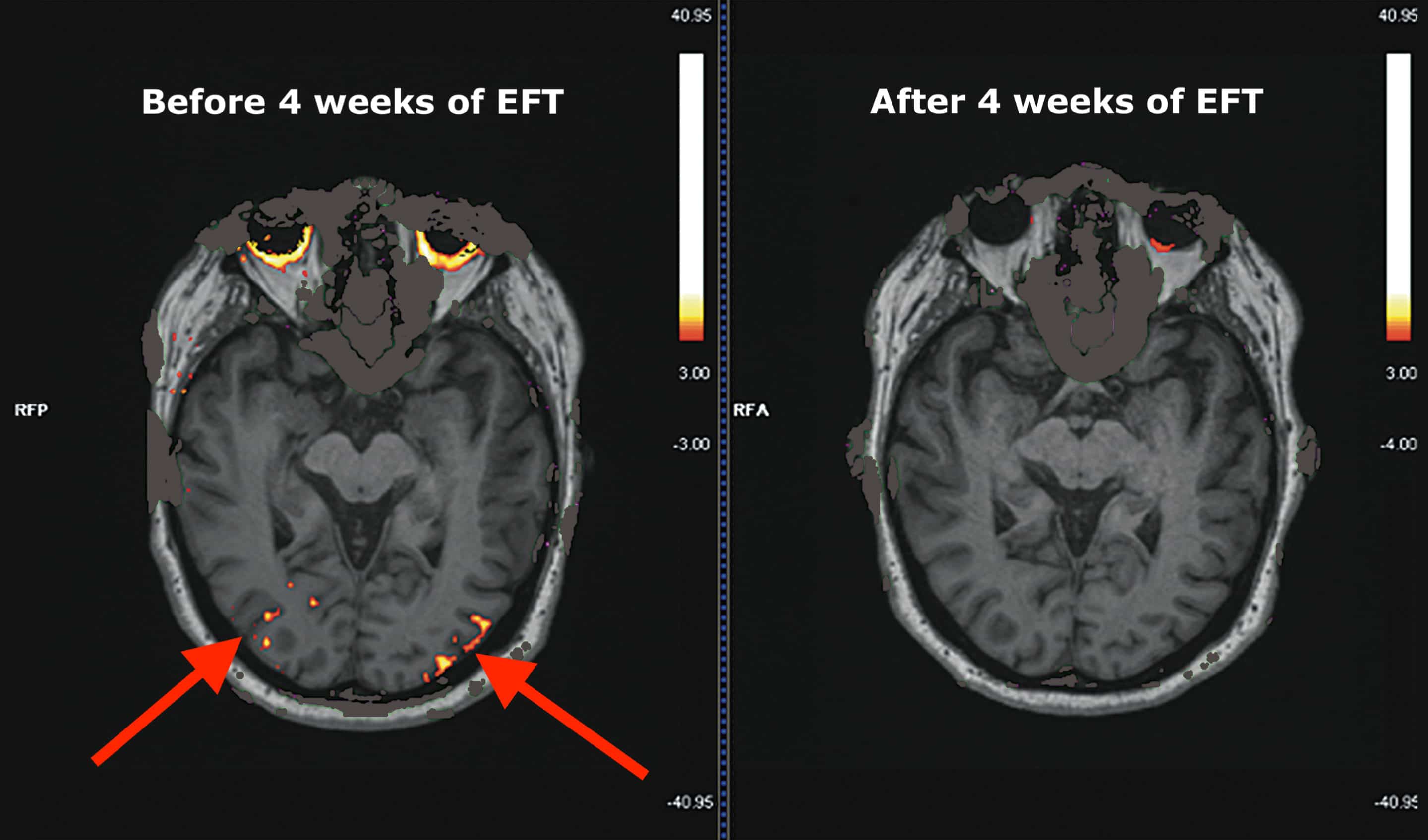 Brain scan images showing the effects of EFT Tapping before and after.